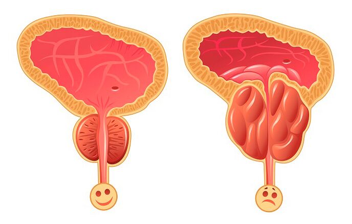 正常和发炎的前列腺