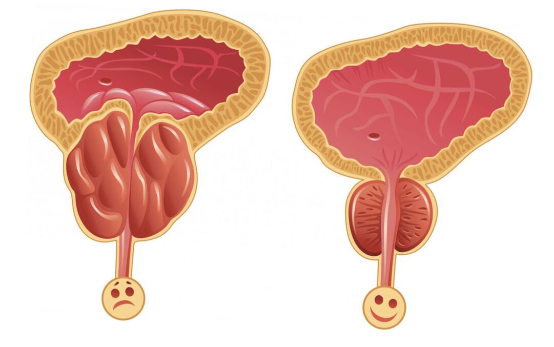 前列腺炎症伴前列腺炎（左）和前列腺正常（右）